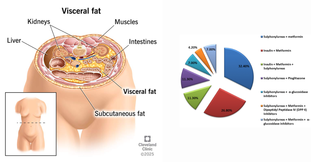 Central Obesity → Muscle Loss → Lean Diabetes